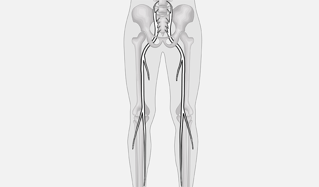 Anatomiczne przedstawienie nerwu kulszowego, który ma swój początek w okolicy lędźwiowej i ciągnie się stamtąd przez pośladki do obu nóg prawie do stóp.