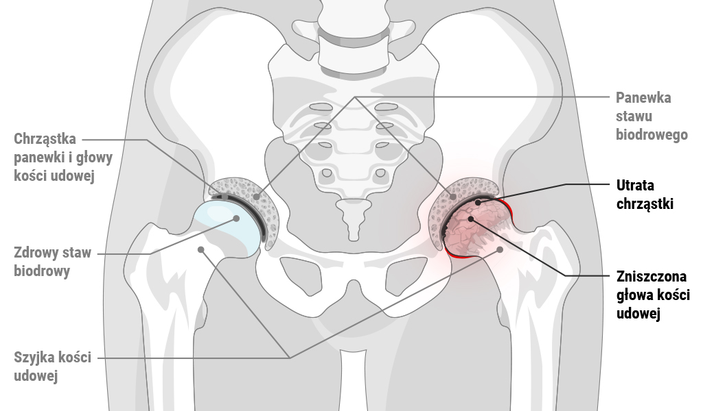 Ból bioder. Przekrój ciała z widoczną miednicą i kośćmi bioder oraz udowymi.