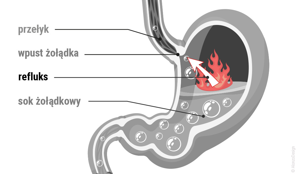 Zgaga - przekrój żołądka