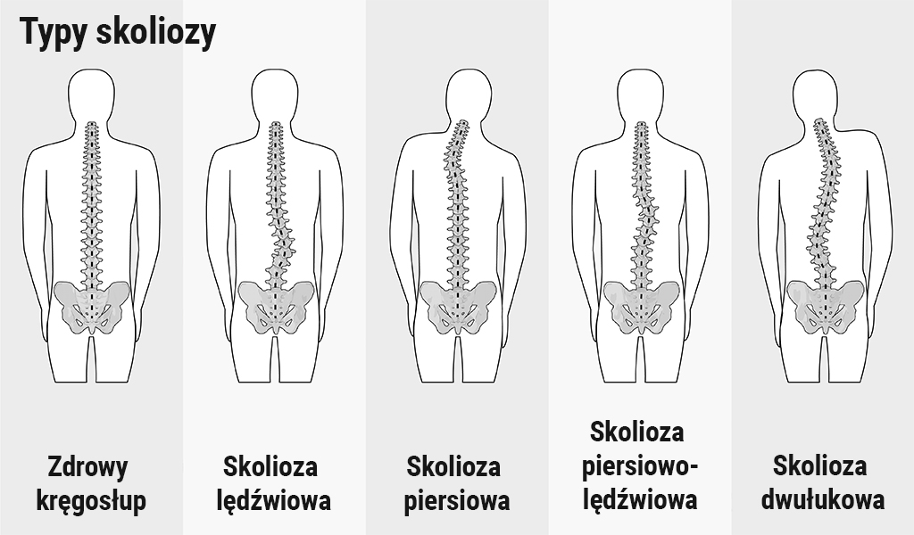 Cztery różne rodzaje skoliozy w porównaniu ze zdrowym kręgosłupem.