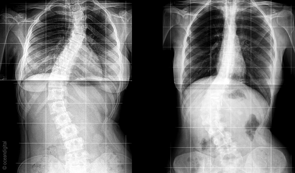 Dwa zdjęcia rentgenowskie kręgosłupa z dwoma rodzajami skoliozy.